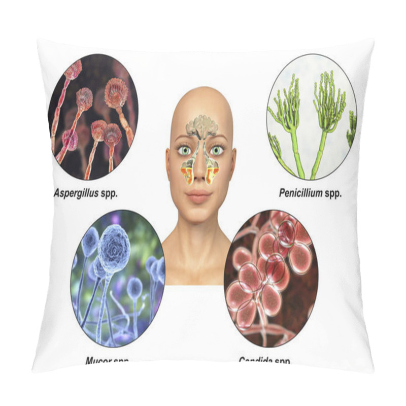 Personality  Fungi As A Cause Of Sinusitis. 3D Illustration Showing Inflammation Of Maxillary Sinuses And Fungi Aspergillus, Penicillium, Mucor And Candida. Chronic Fungal Sinusitis. Labelled Image Pillow Covers