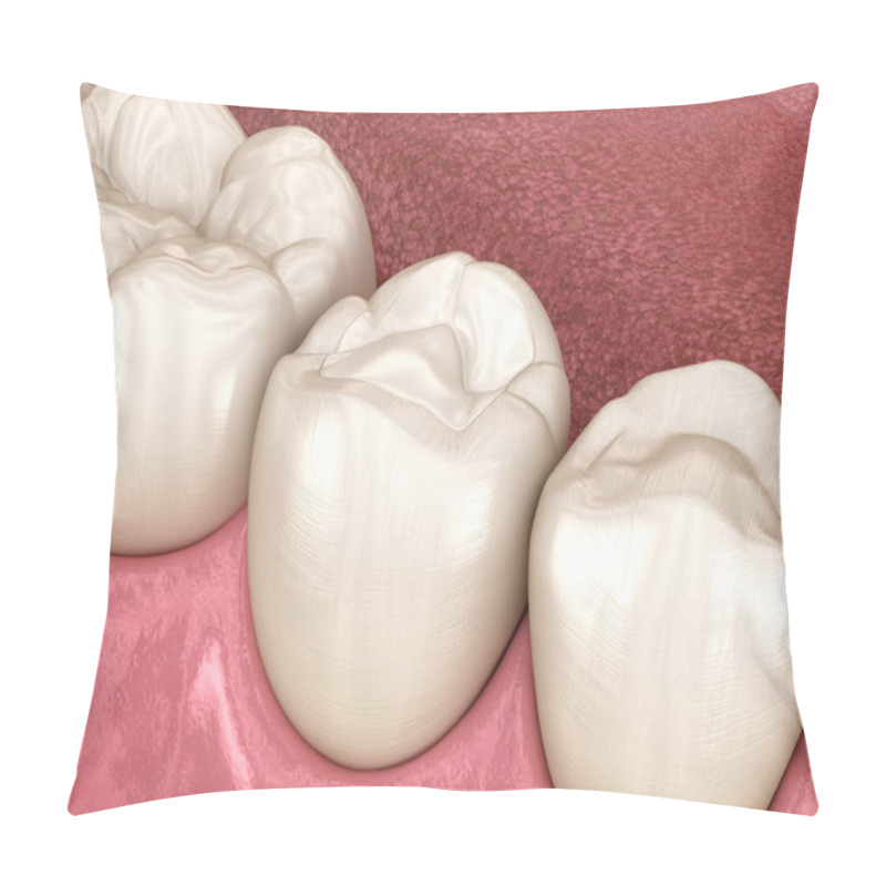 Personality  Premolar Tooth Restoration With Filling. Medically Accurate Tooth 3D Illustration. Pillow Covers