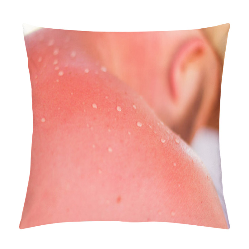 Personality  Close-up View On Red Irritation From A Sunburn Is Shown On The Back And Neck Of A White Male. Selective Soft Focus. Pillow Covers