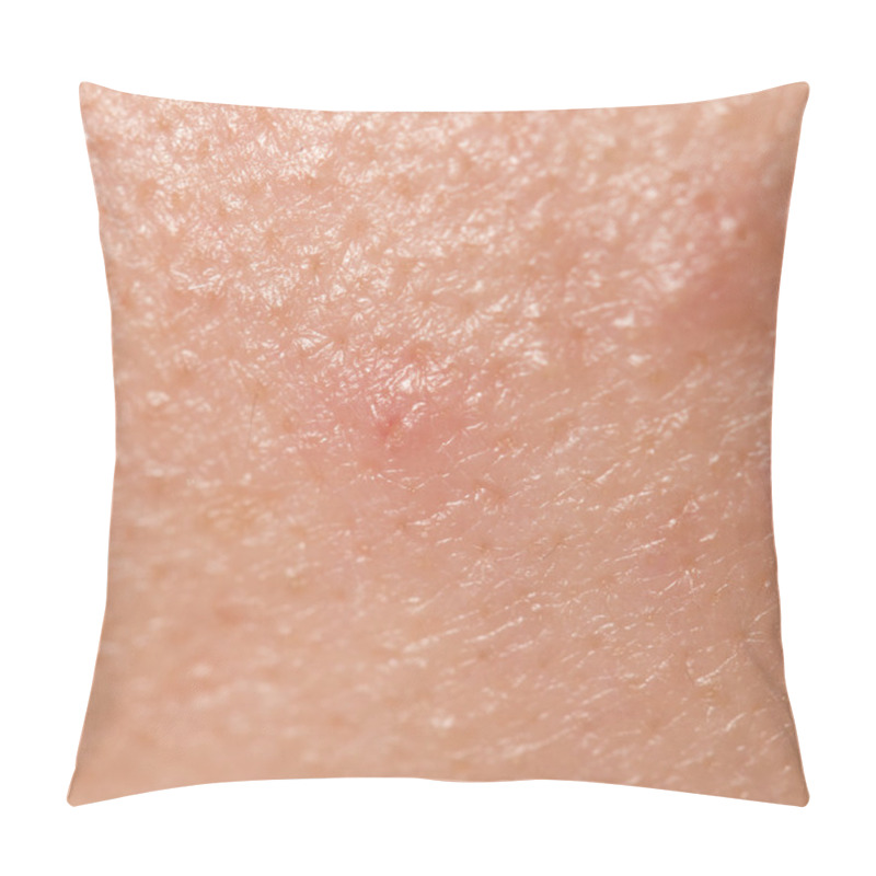 Personality  Pimples On The Skin. Close Pillow Covers