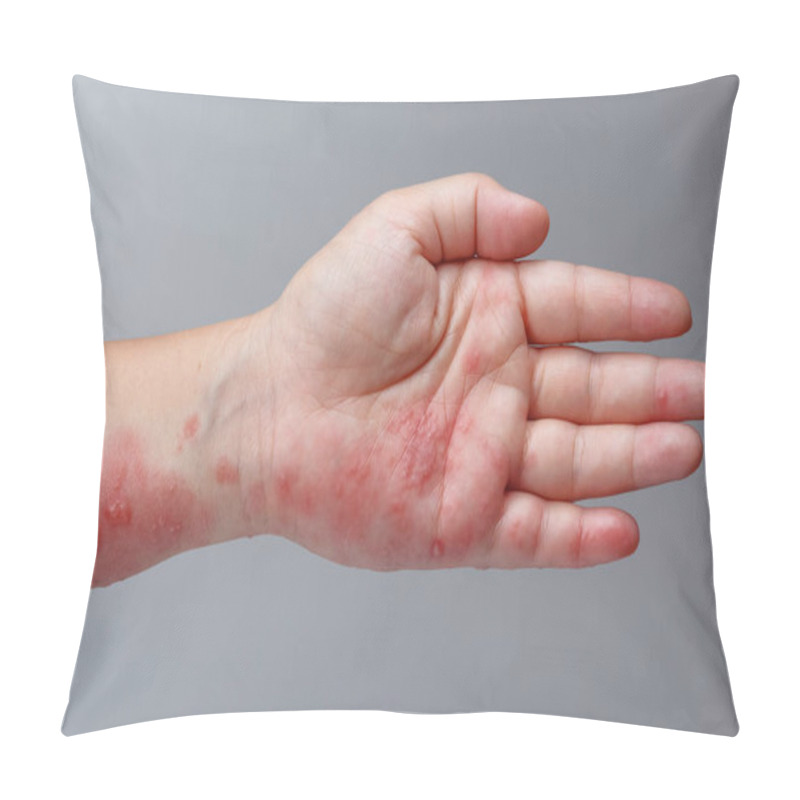 Personality  Shingles, Zoster Or Herpes Zoster Symptoms On Arm Pillow Covers