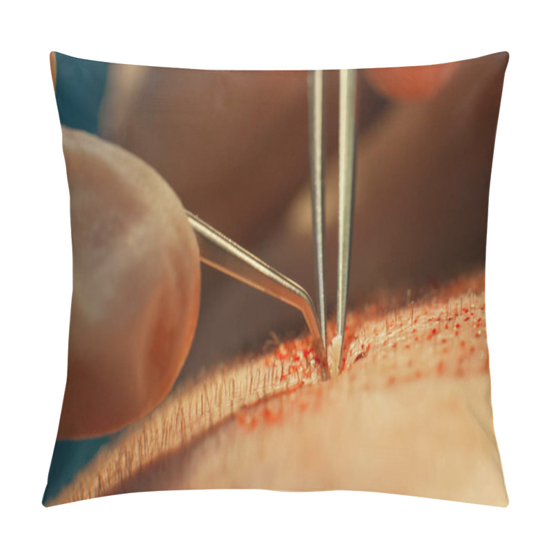 Personality  Macrophotography Of A Hair Bulb Transplanted Into A Hairless Area. Baldness Treatment. Hair Transplant. Surgeons In The Operating Room Carry Out Hair Transplant Surgery. Surgical Technique That Moves Pillow Covers