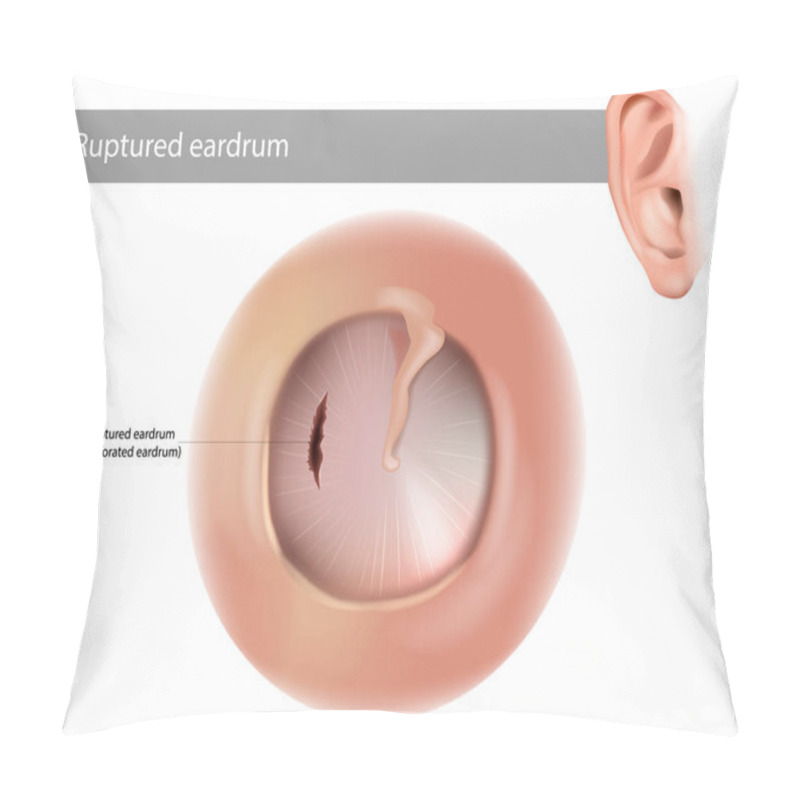 Personality  Ruptured Eardrum Or Perforated Eardrum. Tympanic Membrane Perforation. Pillow Covers