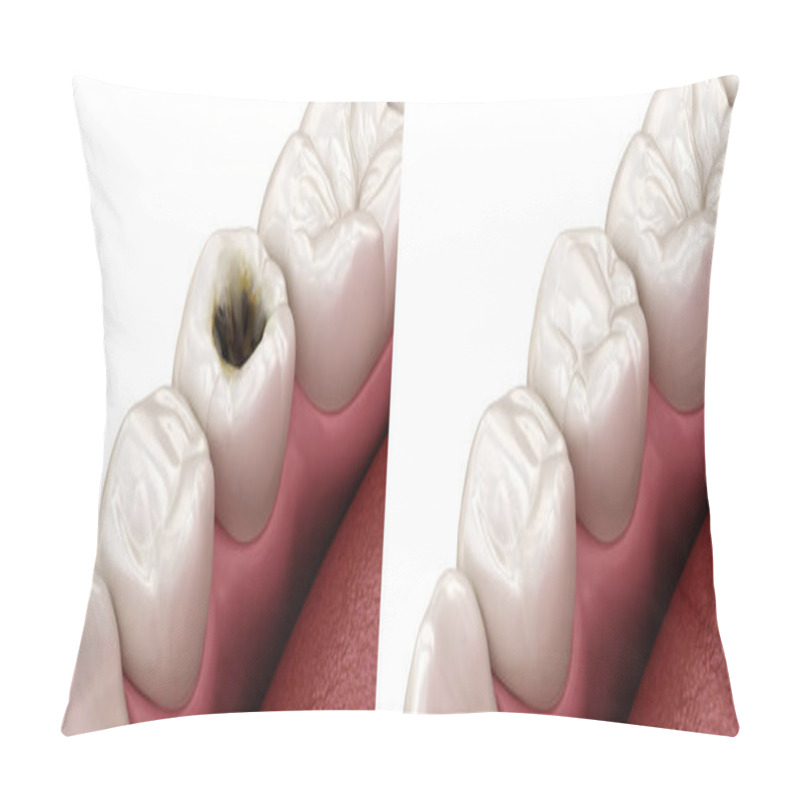 Personality  Premolar Tooth Restoration With Filling After Caries Damage. Medically Accurate Tooth 3D Illustration. Pillow Covers