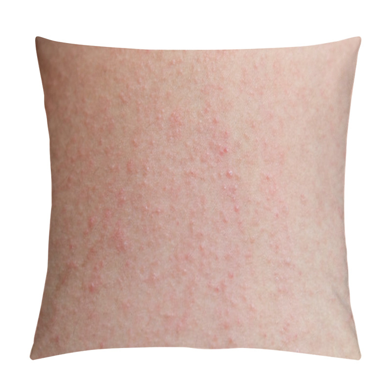 Personality   Allergic Rash Dermatitis Skin Of Patient Pillow Covers