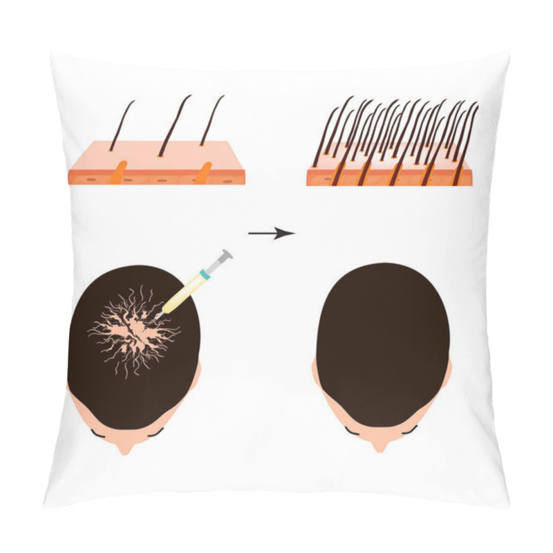 Personality  Treatment Of Alopecia. Bald Spot, Baldness, Alopecia Mesotherapy. Infographics. Vector Illustration On Isolated Background. Pillow Covers