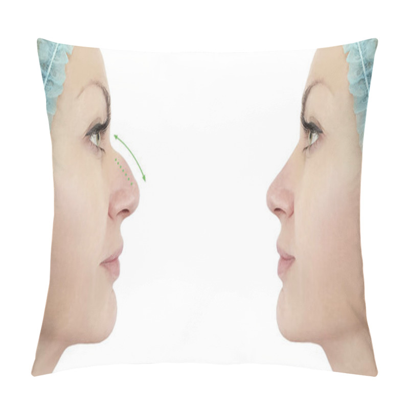 Personality  Woman Nose Correction Before And After Procedures Pillow Covers