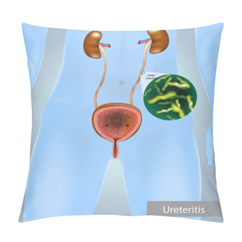 Personality  Ureteritis. Inflammation Of The Ureter. Ureter Infection Pillow Covers