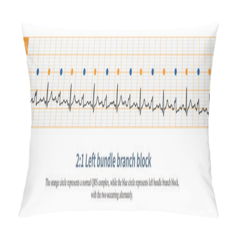 Personality  When A  2:1 Bundle Branch Block Occurs, The Refractory Period Of The Bundle Branch Is Longer Than One Basal Cardiac Cycle But Shorter Than Two Basal Cardiac Cycles. Pillow Covers