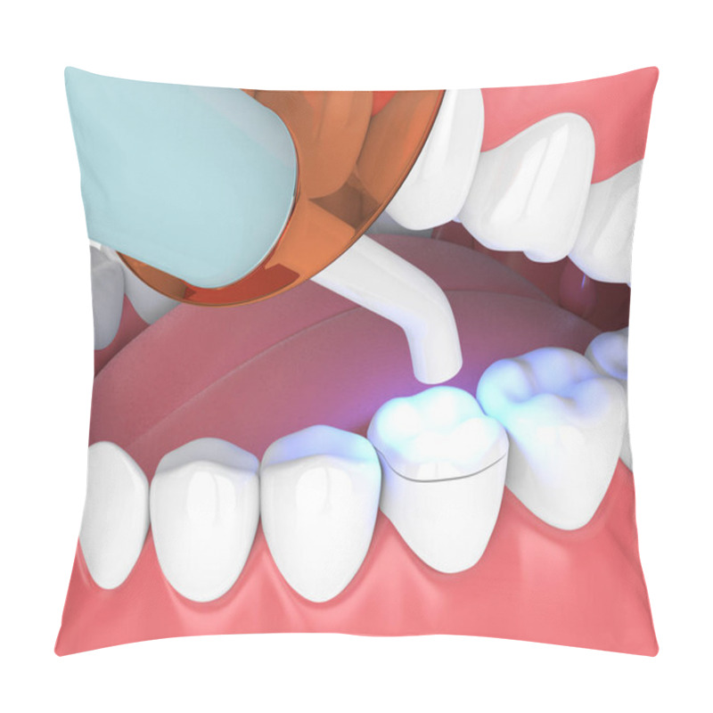 Personality  3d Render Of Jaw With Dental Polymerization Lamp And Light Cured Onlay Filling Over White Background Pillow Covers