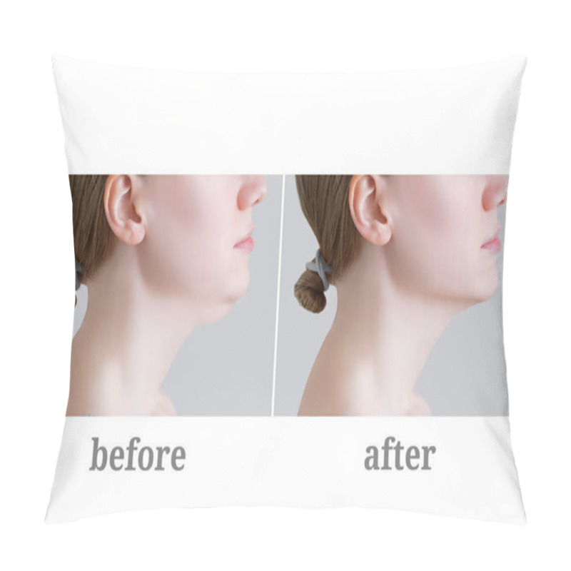 Personality  Double Chin In A Young Caucasian Woman. Photos Before And After Surgery. Pillow Covers