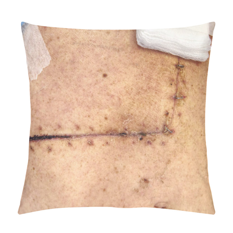 Personality  Patient  With Abdominal Scars After Gallbladder And Bowel Surgery Pillow Covers