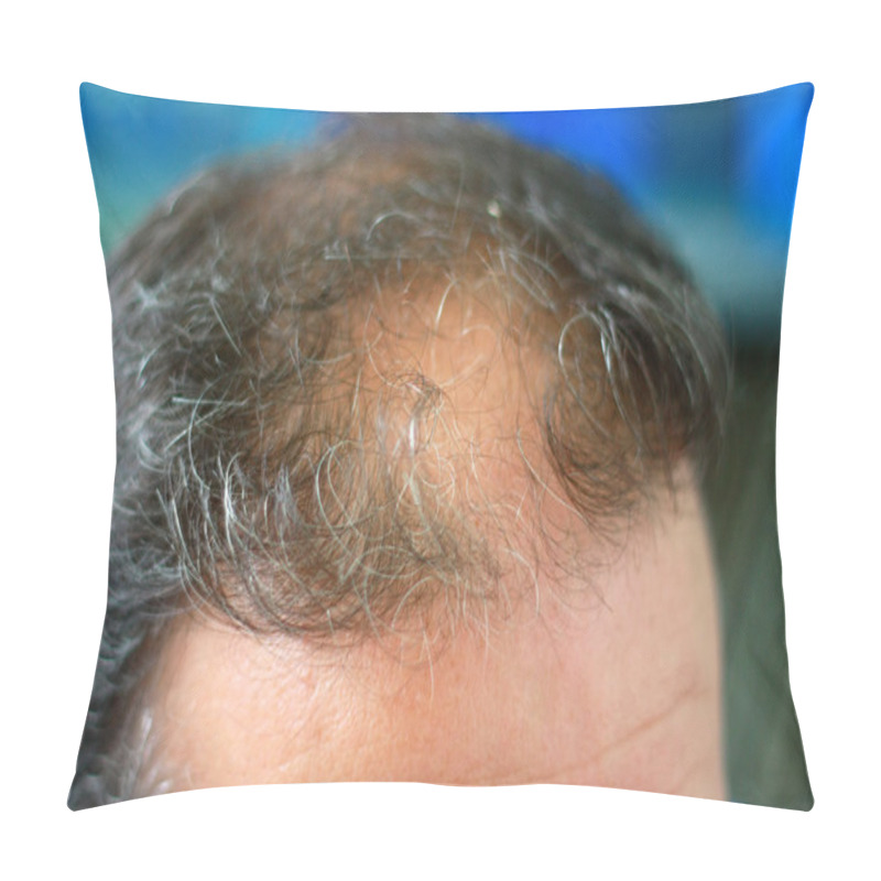 Personality  Male Head With Hair Loss Symptoms Front Side Pillow Covers