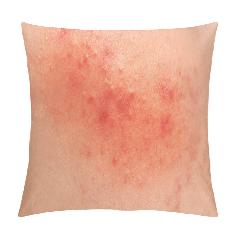 Personality  Acne Treatment Concept Pillow Covers