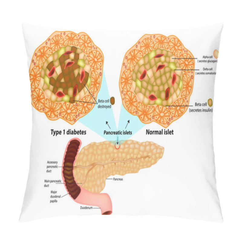 Personality  The Pancreas Has Many Islets That Contain Insulin-producing Beta Cells And Glucagon-producing. Type 1 Diabetes ( Beta Cell Destroyed).  Pillow Covers