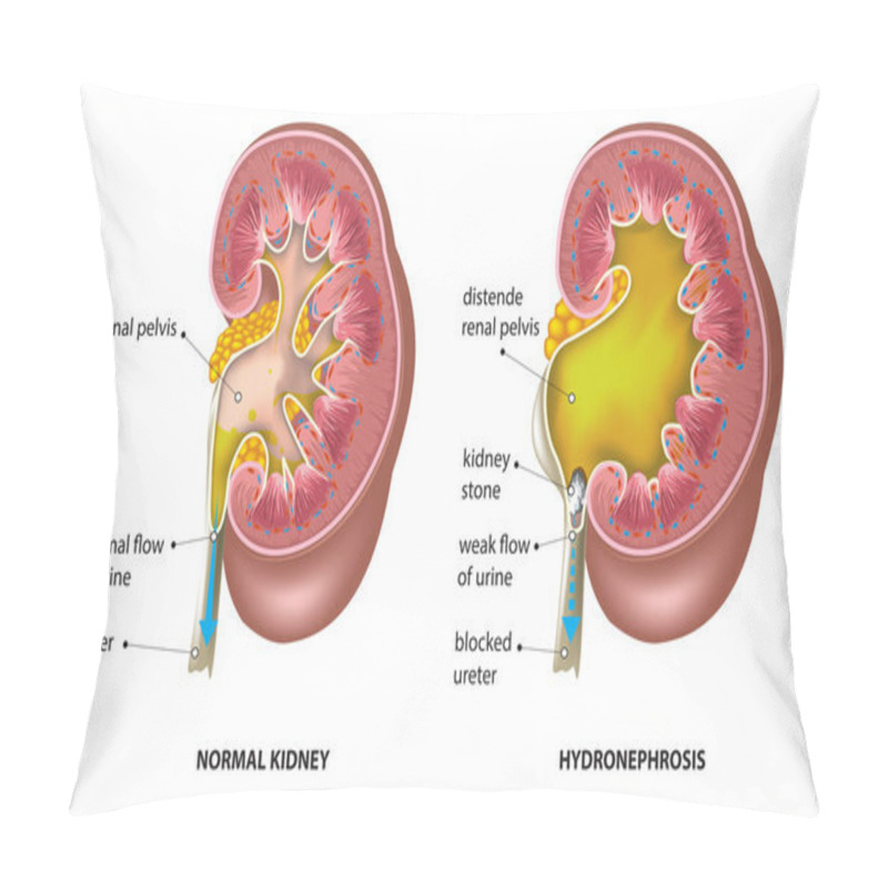 Personality  Kidney Stones - Hydronephrosis Pillow Covers