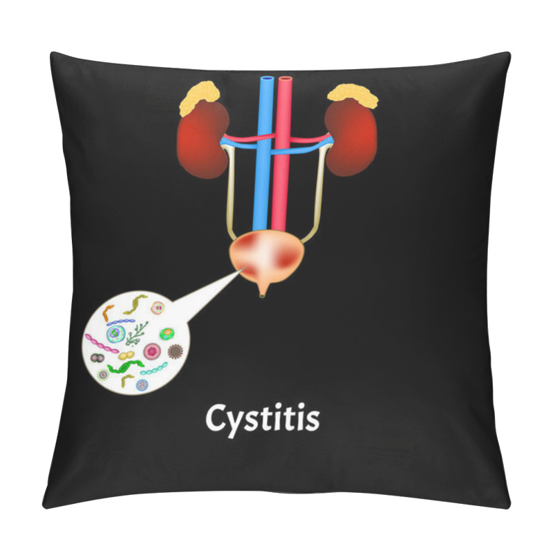 Personality  Cystitis. Inflammation Of The Bladder. The Structure Of The Kidneys And Bladder. Excretory System. Infographics. Vector Illustration. Pillow Covers