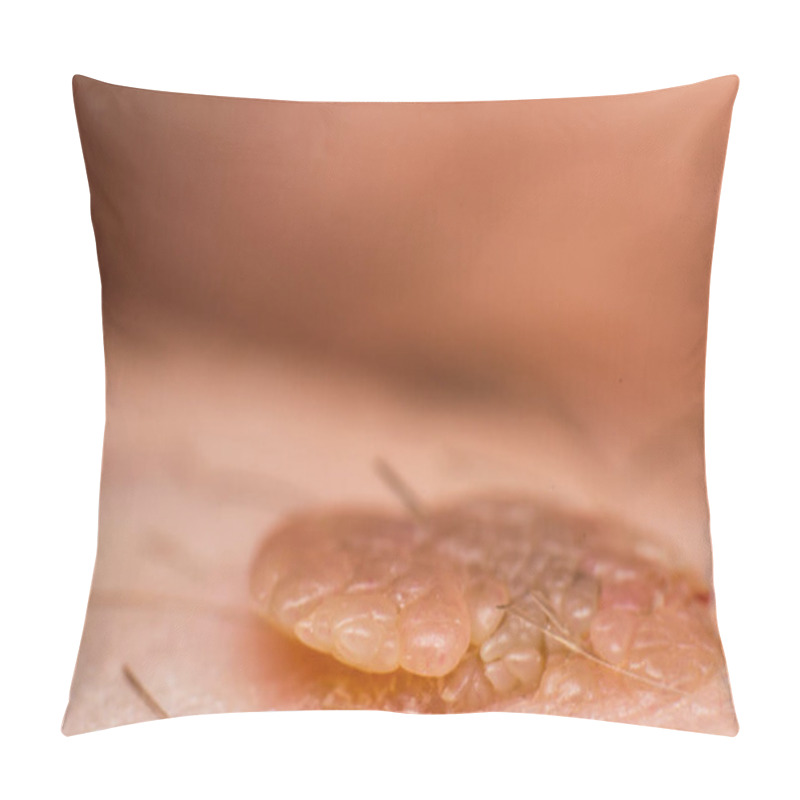 Personality  Macro Photo Of A Skin Wart, Papilloma Virus Infection Pillow Covers