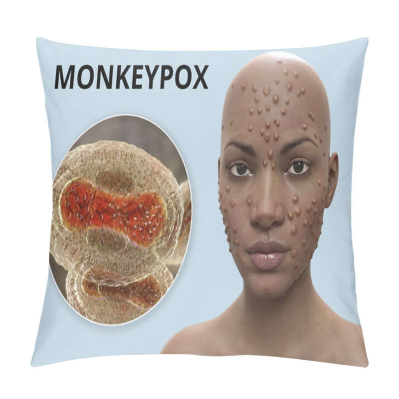 Personality  Patient With Monkeypox, 3D Render, And Close-up View Of Monkeypox Virus, 3D Render. Monkeypox Is A Zoonotic Virus From Poxviridae Family, Causes A Pox-like Disease Pillow Covers