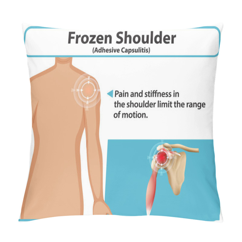 Personality  Illustration Of Adhesive Capsulitis And Shoulder Pain Pillow Covers