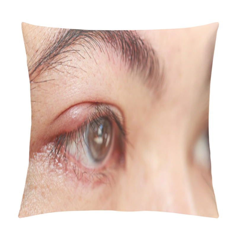 Personality  Right Upper Eyelid Abscess Pillow Covers