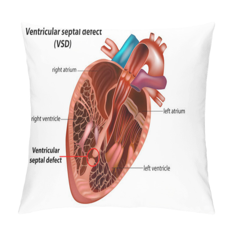 Personality  Ventricular Septal Defect (VSD).Congenital Heart Defect Pillow Covers