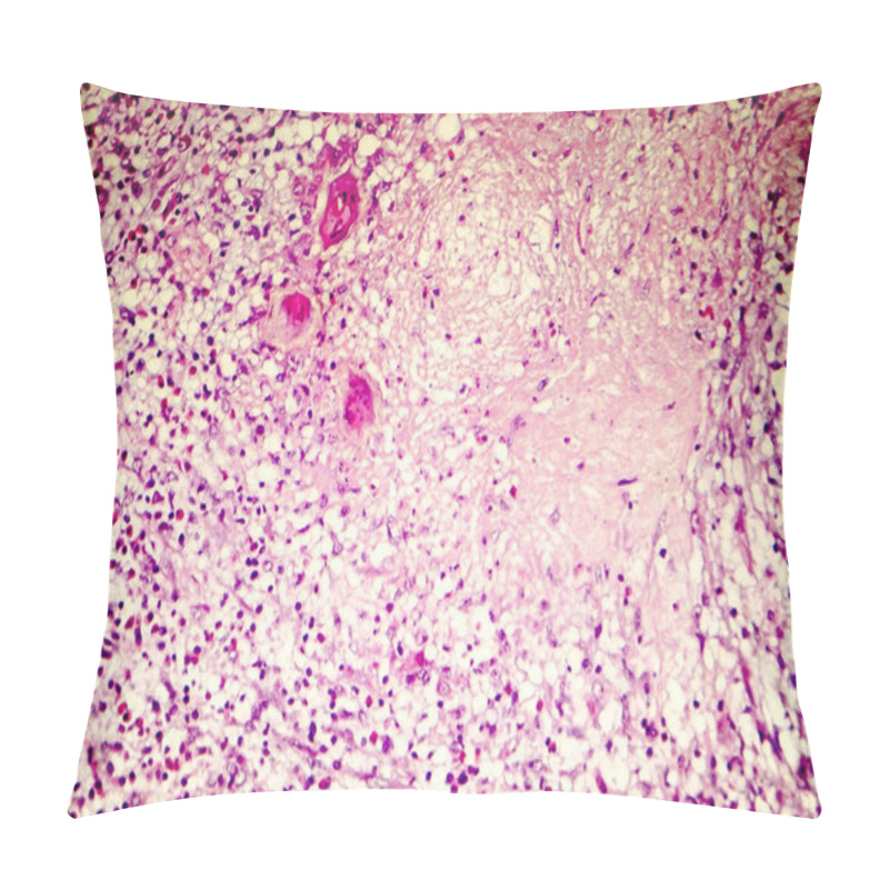 Personality  Liquefactive Necrosis Of The Human Brain, Light Photomicrograph Pillow Covers