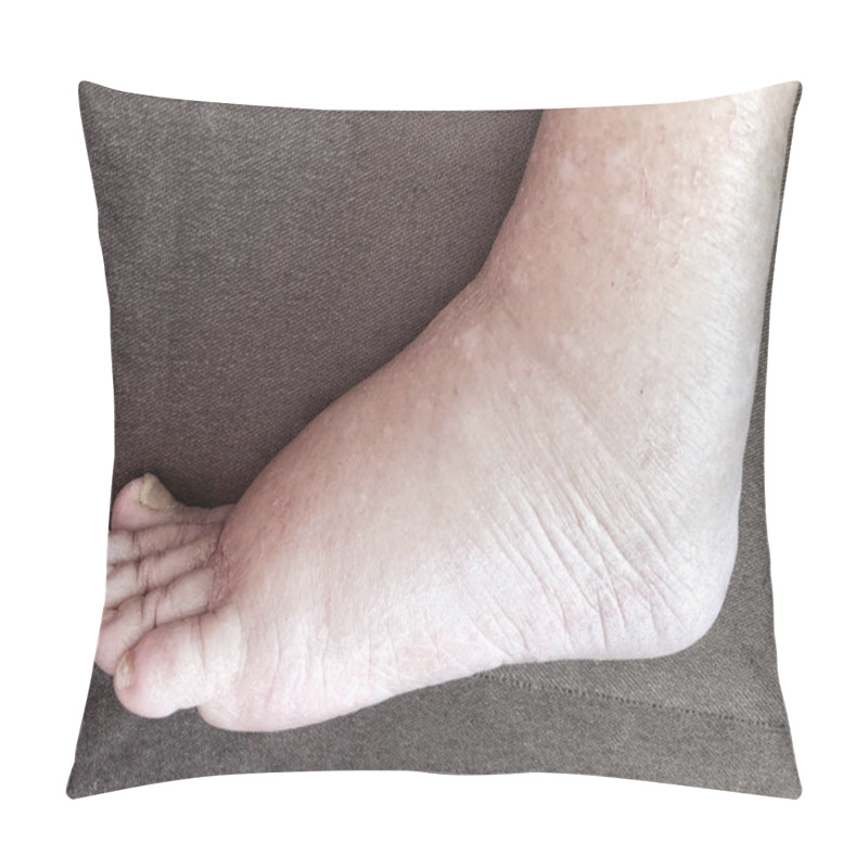 Personality  Closeup Foot Of Diseased Female Patient Who Suffers From Edema Illness Pillow Covers