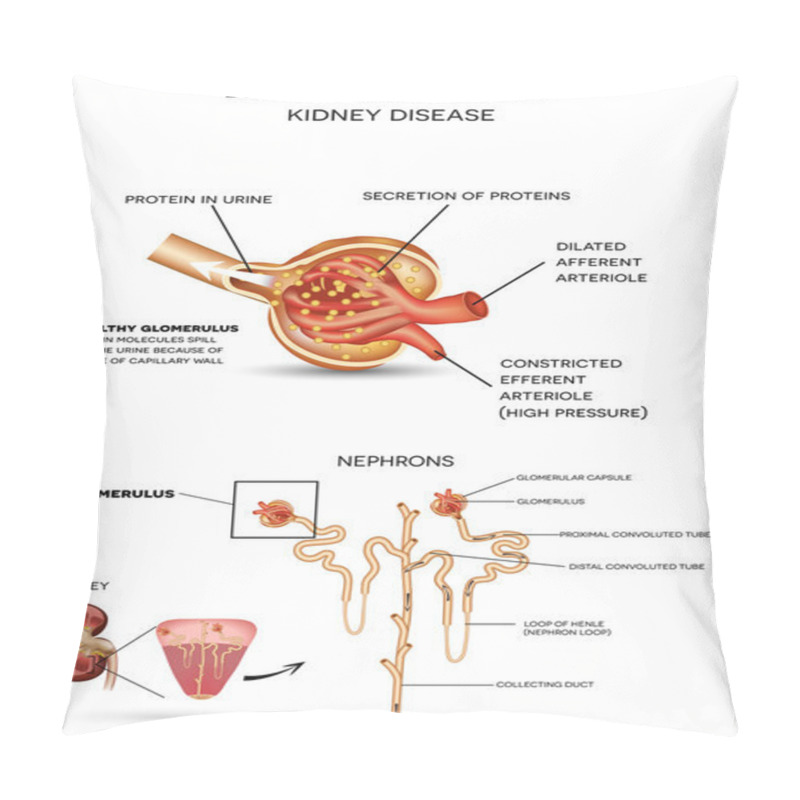 Personality  Diabetic Nephropathy, Kidney Disease Pillow Covers