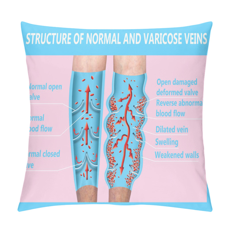 Personality  Varicose Veins On A Female Senior Legs. The Structure Of Normal And Varicose Veins. Pillow Covers