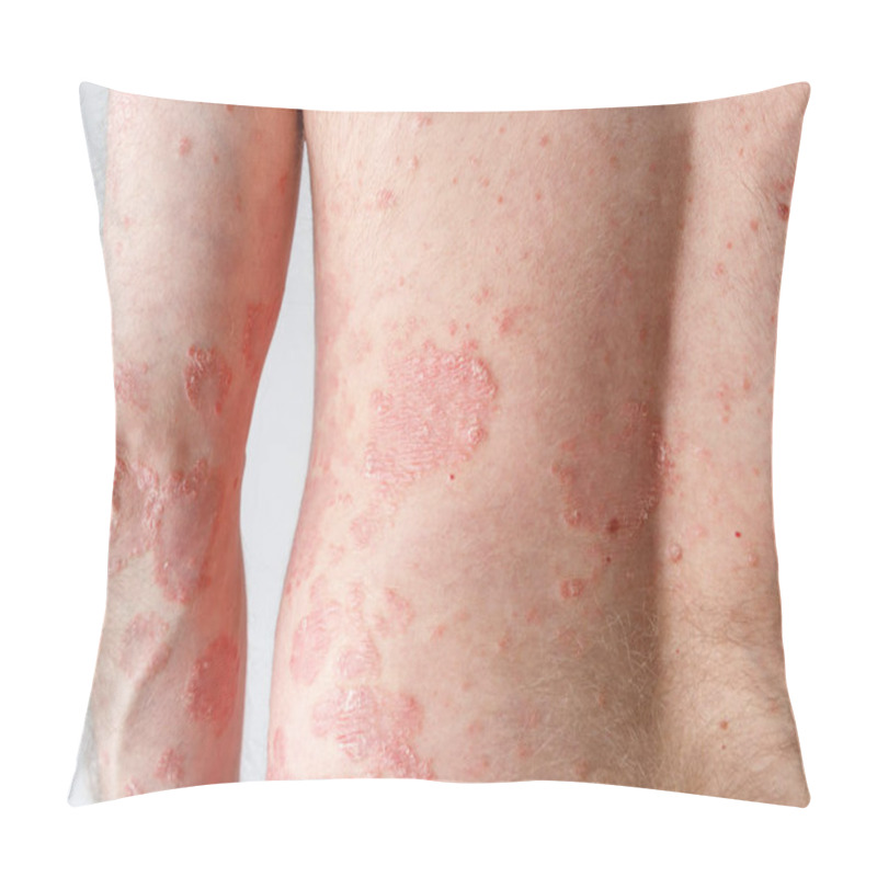 Personality  Papules Of Chronic Psoriasis Vulgaris On Male Hand And Body On Neutral Background. Genetic Immune Disease. Pillow Covers