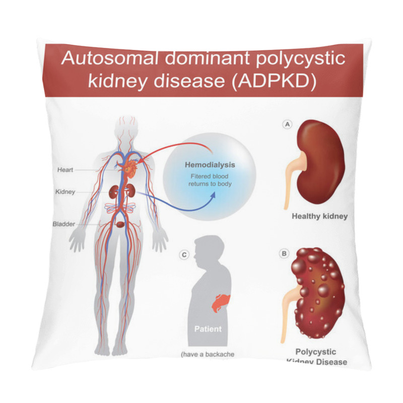 Personality  Autosomal Dominant Polycystic Kidney Disease. Have A Backache And Acute Loin Pain, Enlargement Of One Or More Cysts, Renal Colic, And Acute Kidney Failure. Illustration Pillow Covers