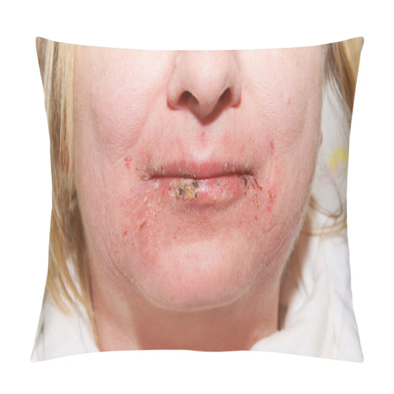 Personality  Skin Disease Pillow Covers