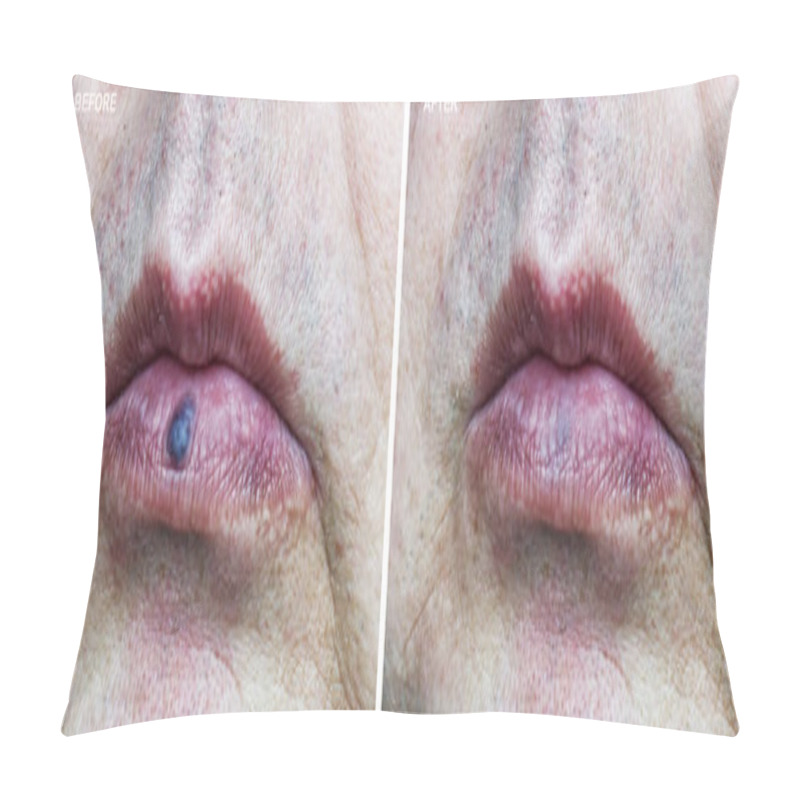 Personality  Image Before And After Removal Of Venous Lake On Lip Of Mouth. Pillow Covers