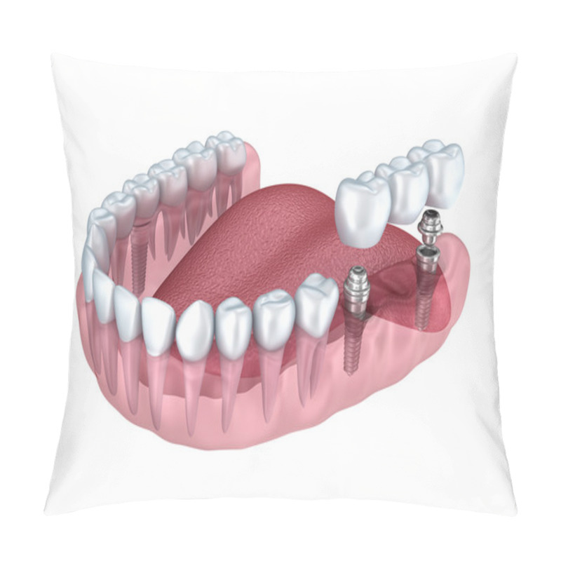 Personality  Dental Titanium Implant Pillow Covers