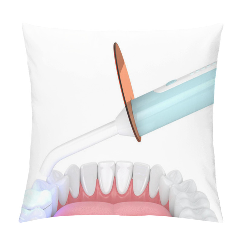 Personality  3d Render Of Jaw With Dental Polymerization Lamp And Light Cured Onlay Filling Over White Background Pillow Covers