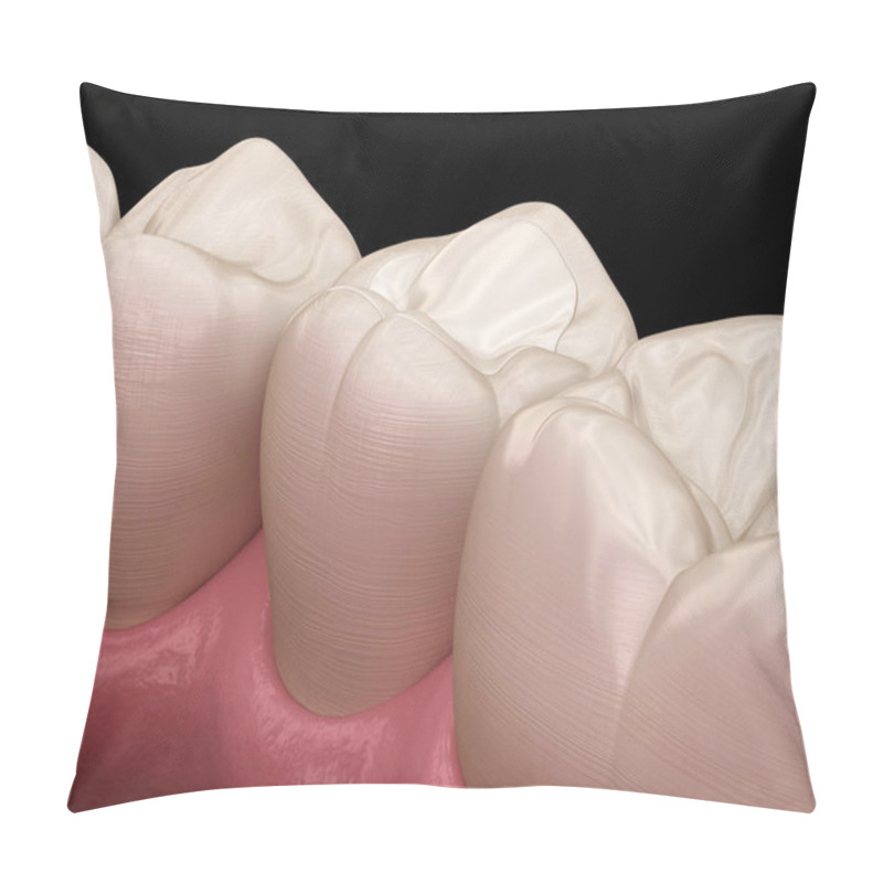 Personality  Premolar Tooth Restoration With Filling. Medically Accurate Tooth 3D Illustration. Pillow Covers