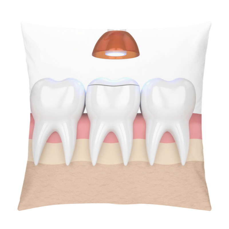 Personality  3d Render Of Teeth With Dental Polymerization Lamp And Light Cured Onlay Filling Over White Background Pillow Covers