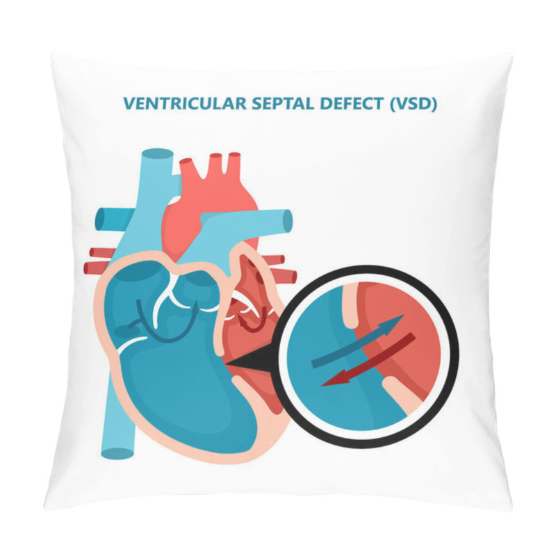 Personality  Ventricular Septal Defect VSD. Human Heart Muscle Diseases Cross-section. Cardiology Concept. Pillow Covers