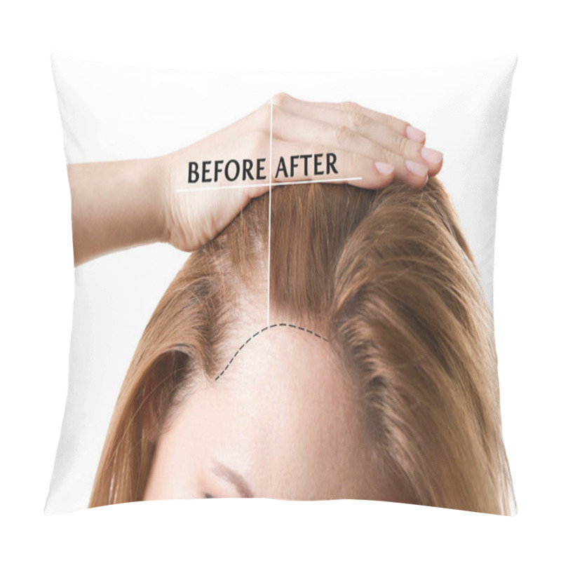 Personality  Woman Before And After Hair Loss Treatment On White Background Pillow Covers