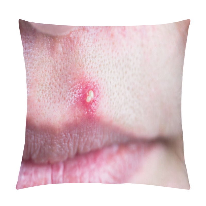 Personality  The Infected Pustulous Acne On Face, Selective Focus On Acne Pillow Covers