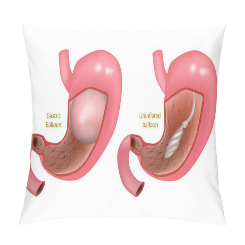 Personality  Intra Gastric Balloon. Orbera Gastric Ballon Inside A Stomach Pillow Covers