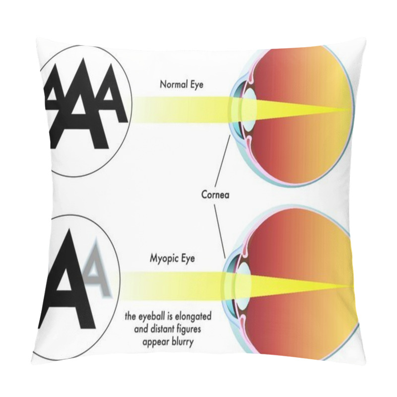 Personality  Medical Illustration Of The Symptoms Of Myopia Pillow Covers