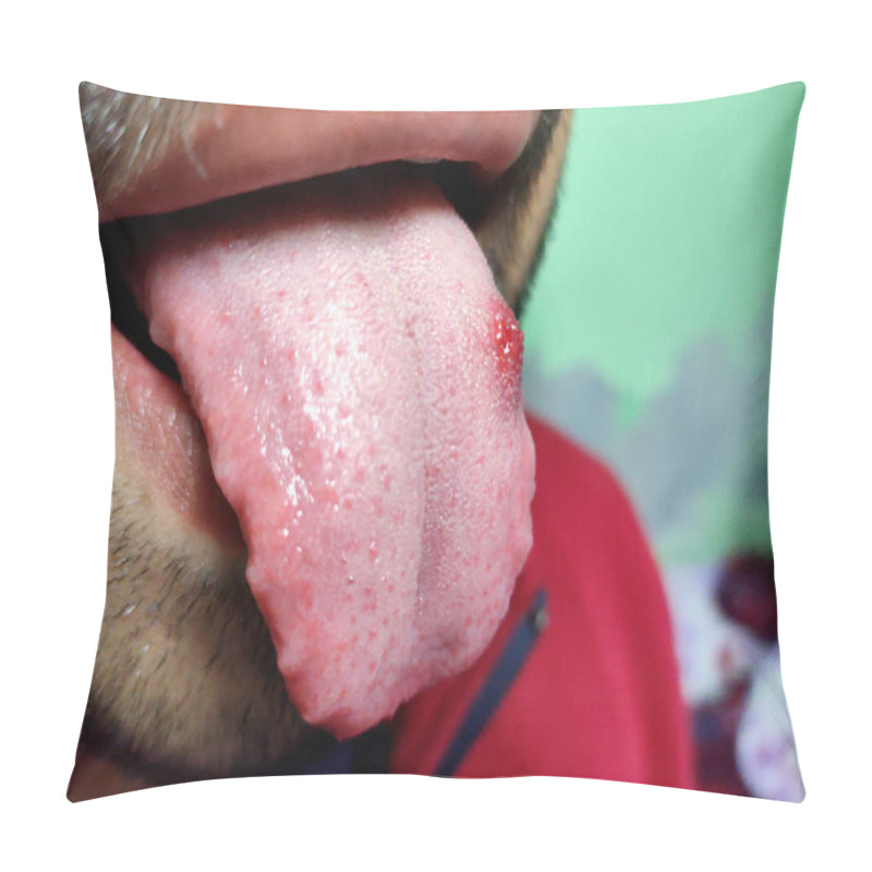 Personality  A Closeup Of A Diseased Tongue In Which A Red Spot Glosses. Burning And Discomfort Of The Tongue Pillow Covers