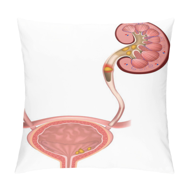 Personality  Stones In The Kidneys. Urolithiasis Disease. Conglomerate Stuck In The Ureter. Bladder. Chronic Pyelonephritis. Vector Illustration. Pillow Covers