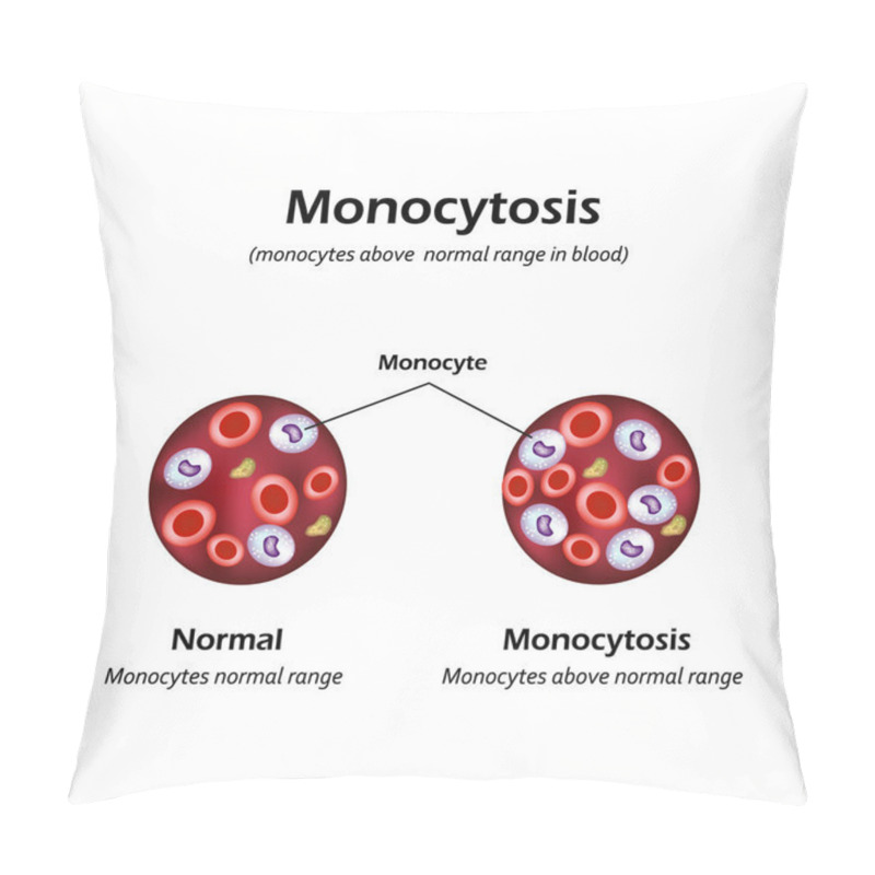 Personality  Monocytes Above The Normal Range In The Blood. Monocytosis. Vector Illustration Pillow Covers