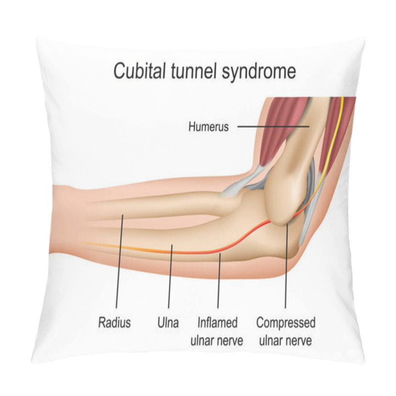 Personality  Cubital Tunnel Syndrome Medical Vector Illustration With English Description Pillow Covers