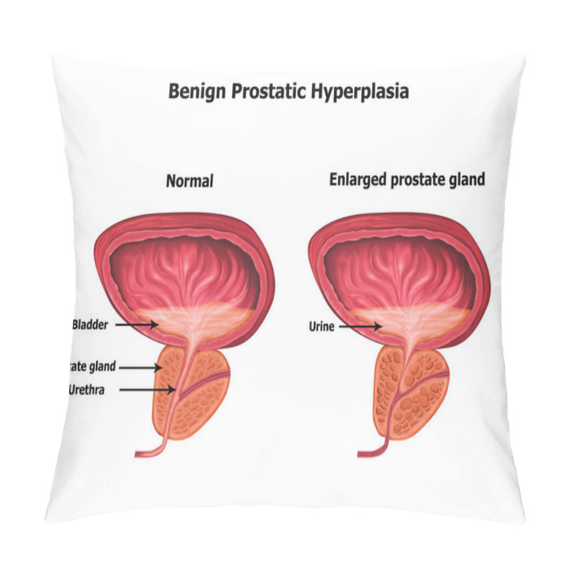 Personality  Illustration Of Human Benign-prostatic-hyperplasia Pillow Covers