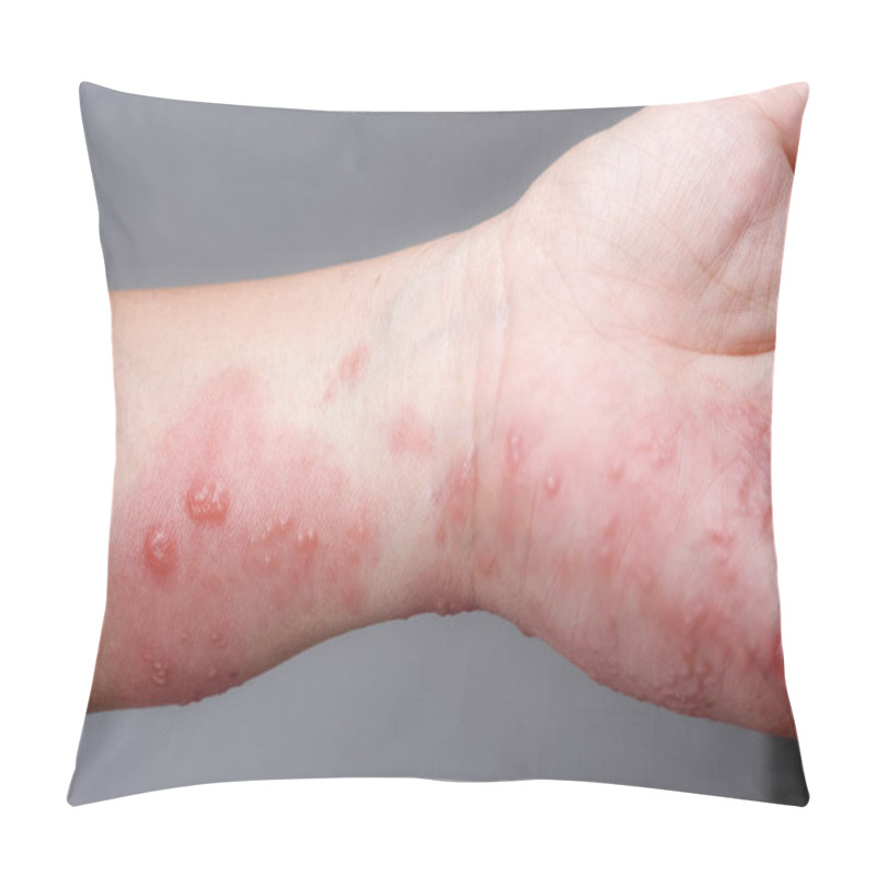 Personality  Shingles, Zoster Or Herpes Zoster Symptoms On Arm Pillow Covers