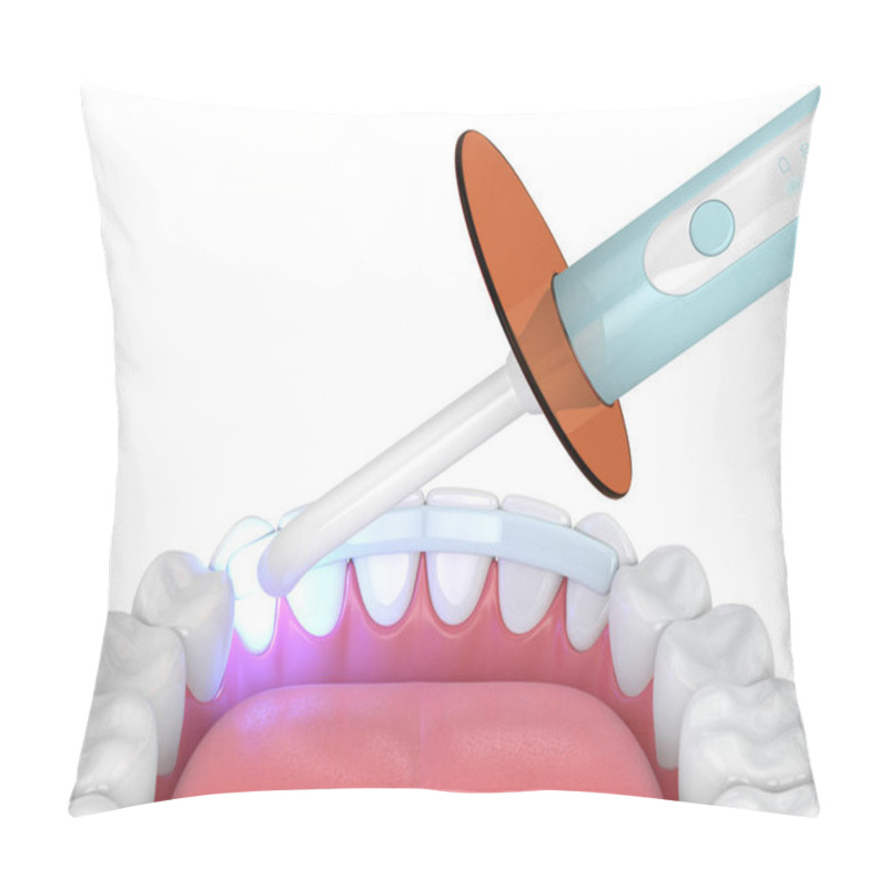 Personality  3d Render Of Jaw With Dental Polymerization Lamp And Dental Fiber Over White Background Pillow Covers